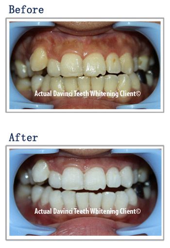 Teeth whitening before and after, client one