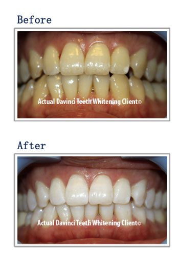 Teeth whitening before and after, client two