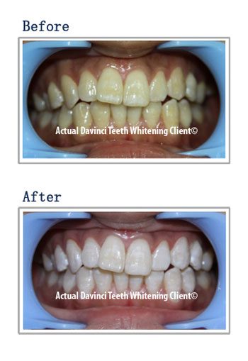 Teeth whitening before and after, client three